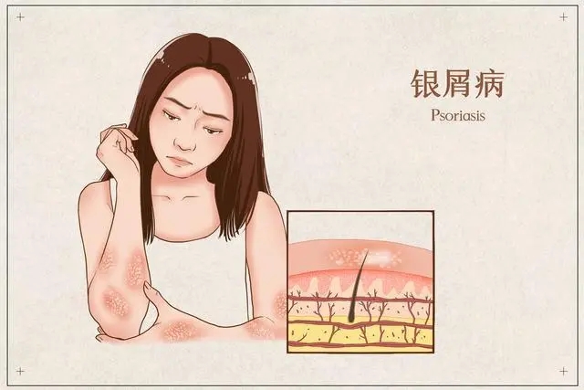 如何准确诊断牛皮癣