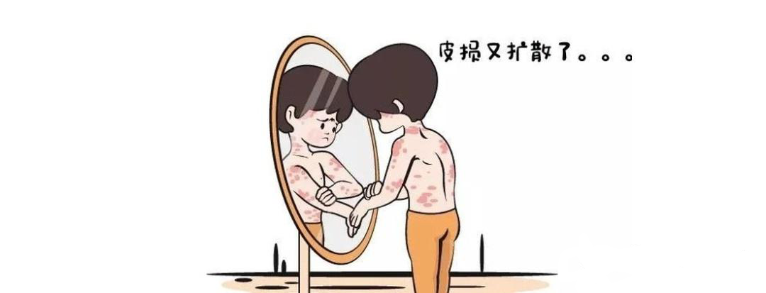 银屑病全身.png